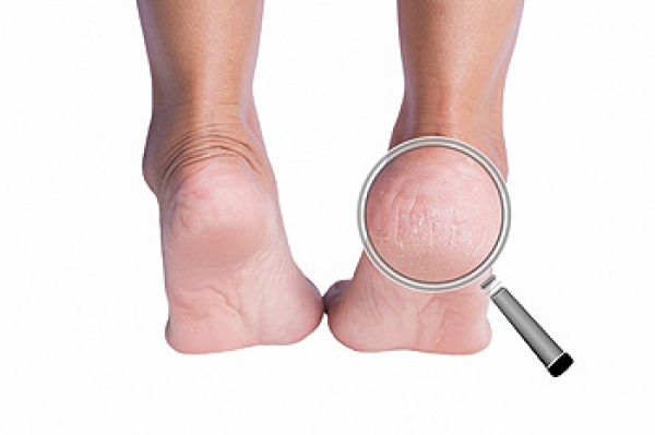 Cracked Heels? How Urea Cream Can Help | Ebanel®