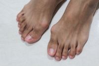The Prevalence of Bunions
